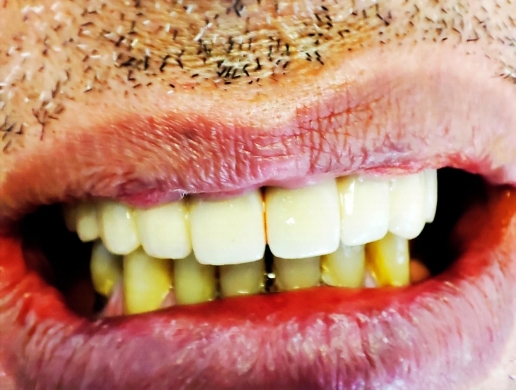 Έλλειψη όλων των δοντιών πάνω μετά